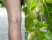 Bạn đã biết cách giảm nhanh suy giãn tĩnh mạch chân bằng trái nhàu chưa?